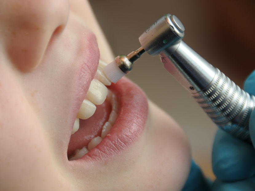 Zahnversiegelung schützt die Zähne
