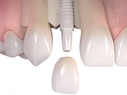 Implantatkrone