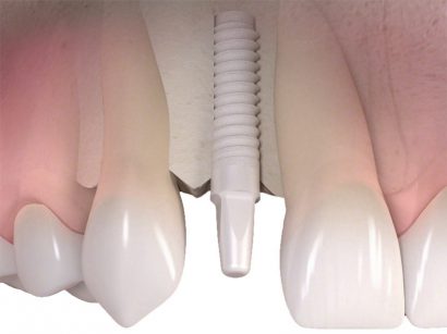Implantat